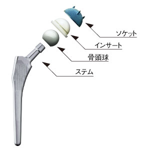 人工股関節は、一般的に骨盤側のソケットとインサート、大腿骨側のステムと骨頭球で構成される。